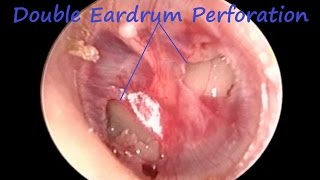 Double Tympanic Membrane  Eardrum  Perforation [upl. by Niltiac]