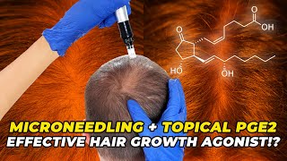 Microneedling  Topical PGE2 – The Most Effective Hair Growth Agonist [upl. by Divaj235]