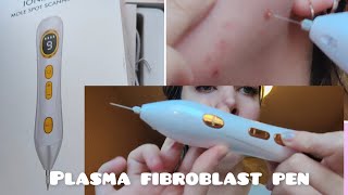 plasma fibroblast pen  alternative to Dermavel  review [upl. by Haleemaj]