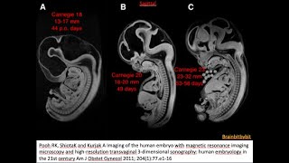 23 Posterior fossa  introductionoverview pontocerebellar hypoplasia Dandy Walker Blakes pouch [upl. by Lacagnia]