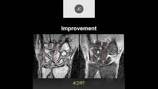 MRI of the Wrist Part 14  Wrist Inflammation [upl. by Enilraep]