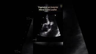 Vegetation at Mitral Valve echo shorts shortsvideo heartcondition [upl. by Kalikow]