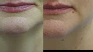 Erbium Laser Resurfacing Before and After Phots [upl. by Nrubliw]