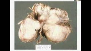 HistopathologyBrain Meningioma [upl. by Deming]