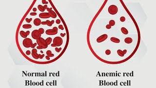 Anemia  Iron deficiency anemia  anemia physiology [upl. by Anowahs]