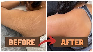 HOW I GOT RID OF MY STRETCH MARKS  NUE CONCEAL NUE CLEAR [upl. by Yelrak]