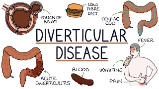 Understanding Diverticulosis and Diverticulitis [upl. by Gawlas]