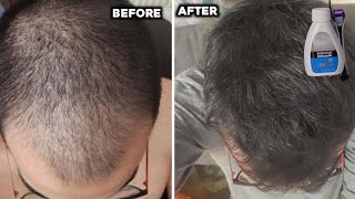 1 month results of minoxidil hair regrowth  minoxidil hair regrowth results  derma roller [upl. by Ducan]