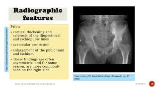 Pagets Disease How to Recognize Medical Documentary [upl. by Aluin]