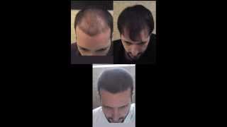 Time Lapse  18 months of hair loss treatment [upl. by Siahc57]