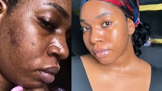 DO THIS FOR 7DAYS TO CLEARACNESCARSHYPERPIGMENTATIONamp MELASMA8 STEP GLASS SKIN SKINCARE ROUTINE [upl. by Eliason]