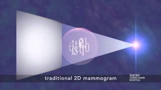 Tomosynthesis  3D Mammogram a New Breast Imaging Technique [upl. by Herzberg718]