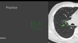 Micronodular lung disease Part 2 [upl. by Alemrac]