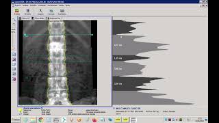 Demonstração de análise de exames de densitometria óssea utilizando software Encore GELunar [upl. by Verbenia971]
