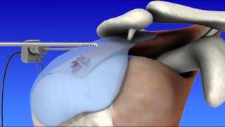 Shoulder Arthroscopy [upl. by Alicirp]