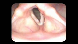 Vocal cord paralysis with nodules [upl. by Phelgen]