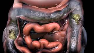 Dolor pélvico por síndrome de intestino irritable [upl. by Ahsekram]