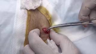 Large Epidermoid Cyst Removal Cysts Whiteheads Dermatolgy Videos [upl. by Asillam222]