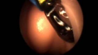 Balloon Sinuplasty for Chronic Sinusitis [upl. by Goodrich640]