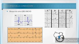 INTERPRETACIÓN DE ELECTROCARDIOGRAMA PATOLOGICO [upl. by Odnuges]