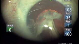 Mature cataract phacoemulsification Crater Divide and Conquer with Downslope Sculpting [upl. by Atikram499]