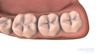 Pit and fissure sealants  Lapointe dental centres [upl. by Flint]