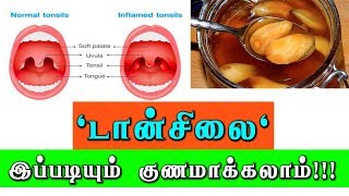 டான்சில்க்கு எளிய வீட்டு வைத்தியம் Tonsils and Adenoids treatment [upl. by Angelica930]