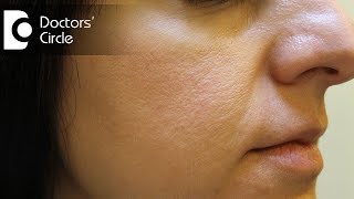 How to remove open pores of face permanently by homeopathic medicine  Dr Karagada Sandeep [upl. by Mignon]