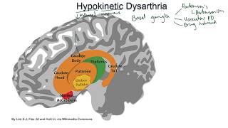 Hypokinetic Dysarthria  examples and tutorial [upl. by Desireah]