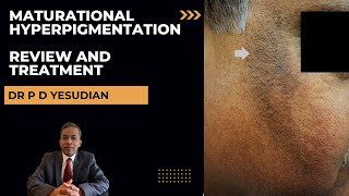 Dark marks on cheeks Maturational hyperpigmentation  review and treatment [upl. by Nitsuj]