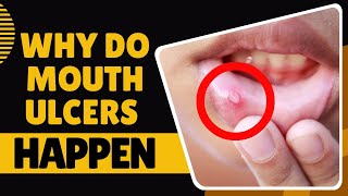 What Causes Mouth Ulcers [upl. by Nahgaem]