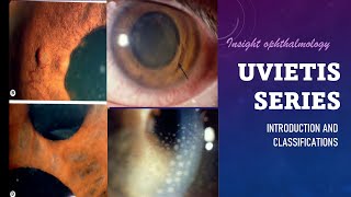 UVEITIS SERIES Classification Types and Pathology of Uveitis [upl. by Ingrim40]