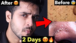 How to Remove Blackheads Whiteheads Naturally  Tips To Remove Whiteheads Blackheads From FACE [upl. by Imojean]