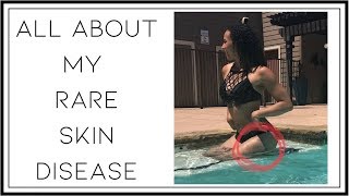 All About My Rare Skin Disease  Linear Morphea Scleroderma Health Series [upl. by Rizan]