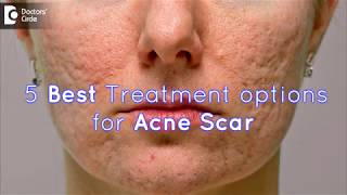 5 Best Treatment options for Acne Scar  Dr Sankeerth Vijayakumar [upl. by Aihsram]