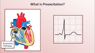 Advanced EKGs  WolffParkinsonWhite WPW Syndrome [upl. by Eitsirc]