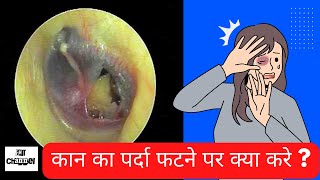 Part1 कान का पर्दा फटने पर क्या करे Ruptured ear drum I Traumatic eardrum perforation I [upl. by Silden]