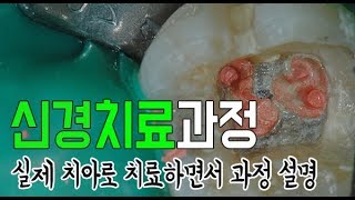 치아 신경치료 과정 실제 치아로 치료하면서 과정 설명 [upl. by Sessylu]