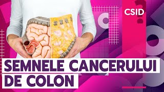 Cancerul de colon 10 semne care să te îngrijoreze [upl. by Ailedo]