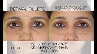 Dermal Fillers Under Eye Hollows amp Pigmentation Tear Trough Treatment by Dr Akshay G Nair [upl. by Reema]