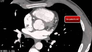 Left Anterior Descending Coronary Artery Anatomy on Coronary CTA [upl. by Ymas]