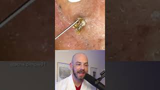 Derm reacts to massive blackhead removal dermreacts doctorreacts blackheadextraction [upl. by Wolford480]