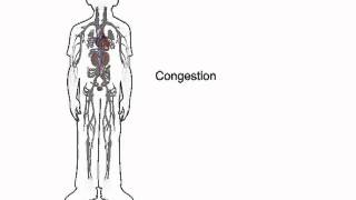 How heart failure causes fluid accumulation  wwwheartfailuremattersorg [upl. by Prosper]