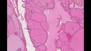 Histopathology ThyroidColloid goiter [upl. by Ades297]