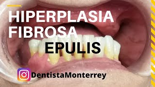 EPULIS HIPERPLASIA Fibrosa👅Causada por Prótesis Dentales [upl. by Erihppas737]