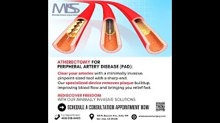 Clear Arterial Blockage With Atherectomy at MISS [upl. by Swanson]