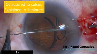 IOL sutured to sulcus in 1 minute [upl. by Irish]