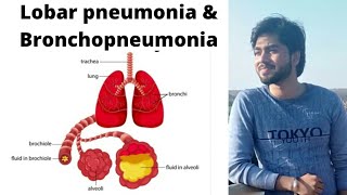 Pneumonia  Lobar pneumonia and BronchopneumoniaBy Abhishek sir [upl. by Einahpet440]