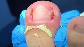 Trimming and Removing Huge Ingrown Toenails [upl. by Sigvard118]