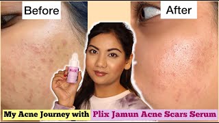 Plix Acne Marks Treatment Serum Review  My Acne Journey with Pictures [upl. by Olly]